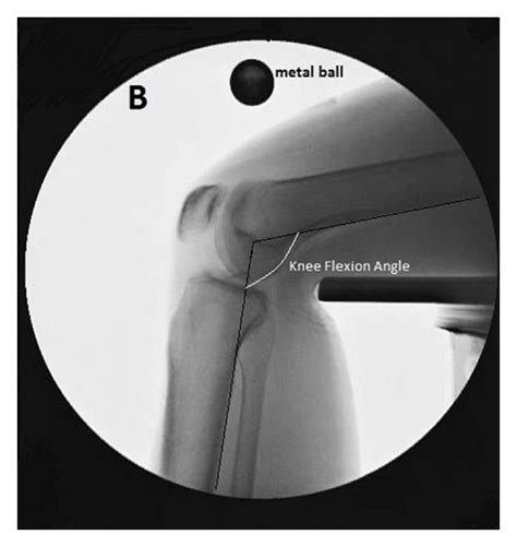 Analysis Of The Fluoroscopic Images A Anatomical Landmarks Used In