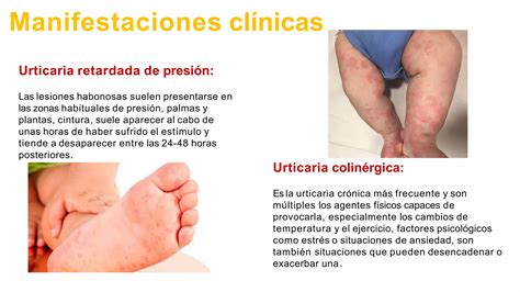 Urticaria Y Angioedema En Pediatria 269373 Downloable 2032835 Pptx