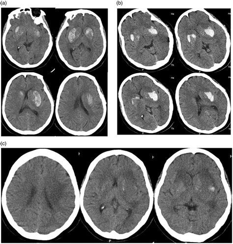 Isolated Bilateral Large Basal Ganglia Haemorrhage Following A