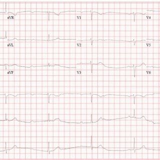 Presenting Ecg Which Demonstrates Third Degree Av Block With A Narrow