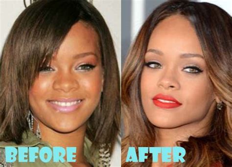 Rihanna Plastic Surgery Before and After Nose Job - Lovely Surgery ...