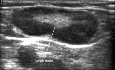 Shotty inguinal lymph nodes - mabezy