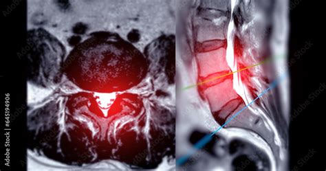 MRI L-S spine or lumbar spine Axial and sagittal T2 technique with ...