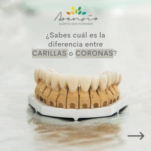 Conoces La Diferencia Entre Carillas Y Coronas Dentales Dental