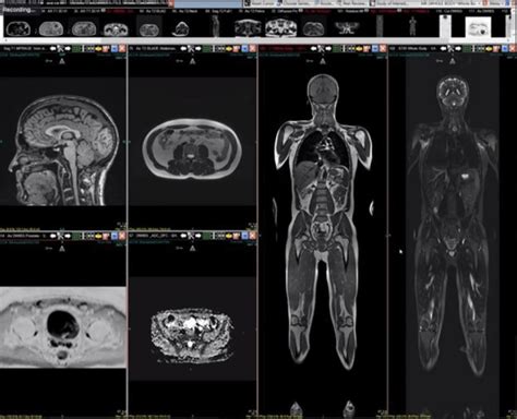 Mri Full Form In Medical Magnetic Resonance Imaging Javatpoint