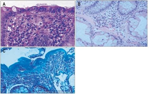 Pathologic finding of microscopic colitis. (A) Lymphocytic colitis (H&E... | Download Scientific ...