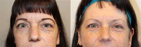 Blepharoplasty Upper Eyelid Before And After