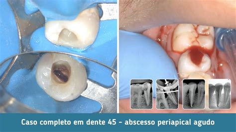 Caso Cl Nico Completo Abscesso Periapical Agudo Em Dente Youtube