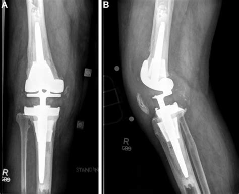 Rotating Hinge Revision Total Knee Arthroplasty For Treatment Of Severe