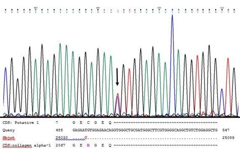 Dna Sequence Chromatogram Of A Heterozygous Affected Individual With Download Scientific