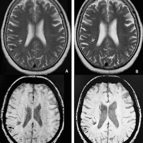 Axial T2 Weighted MR Images Showing A Flow Void In The Right Temporal