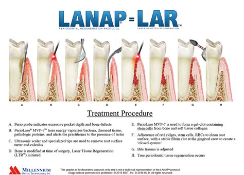 Lanap Laser Therapy Fullerton Ca Anna K Talmood Dds