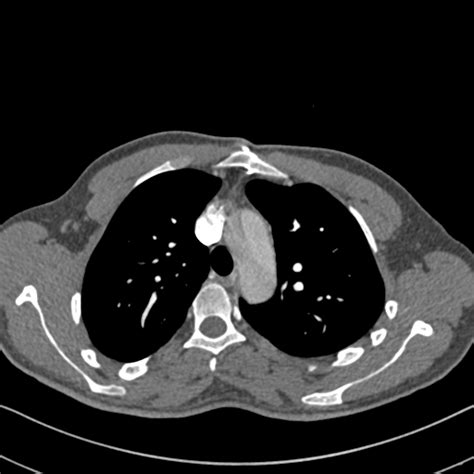 File Marfan Syndrome With Ascending Aortic Aneurysm And Stanford A