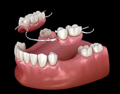 Partial Dentures | Pro Dental Dallas