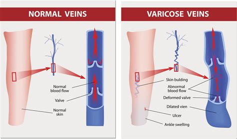 Venous Bleed