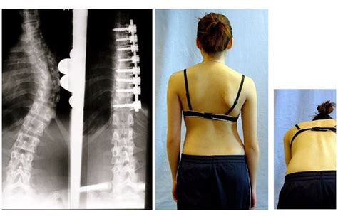 Dextroscoliosis: Definition, Causes, Symptoms, And, 57% OFF