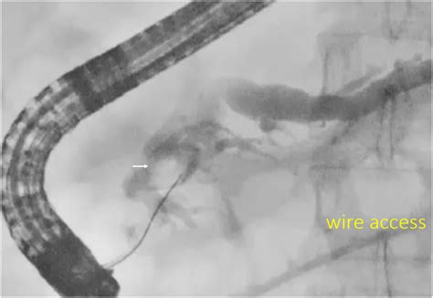 Pancreatoscopy Guided Laser Lithotripsy To Manage Obstructing Intraductal Pancreatic Calculi