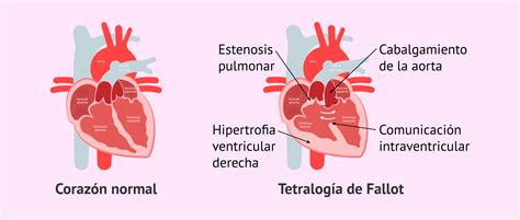 Qu Es La Tetralog A De Fallot Y C Mo Influye En El Embarazo