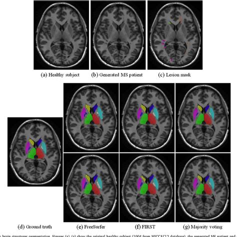 Figure 6 From Evaluating The Effect Of Multiple Sclerosis Lesions On Automatic Brain Structure