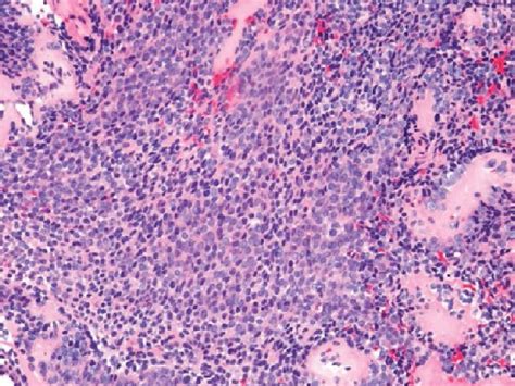 Ewing Sarcoma Histology