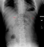 Interpreting An Abdominal X Ray Kub Stepwards