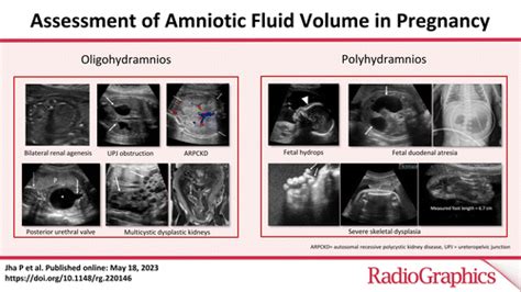 Assessment Of Amniotic Fluid Volume In Pregnancy Radiographics