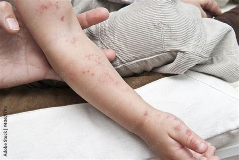 Sintomas del herpes zoster en el brazo de un niño Stock Foto Adobe Stock