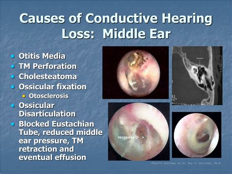 Ppt Hearing Loss Powerpoint Presentation Free Download Id 9342137