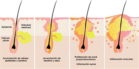 Acne Clinic Tratamiento Personalizado Individualizado Para Tratar El