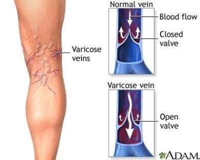 varicose veins | Medicamusae