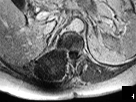 Saline Infused Bipolar Radiofrequency Ablation Of High Risk Spinal And