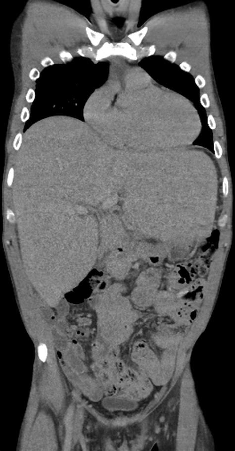 A Rare Cause Of Severe Hepatomegaly With An Improving Outcome Bmj Case Reports