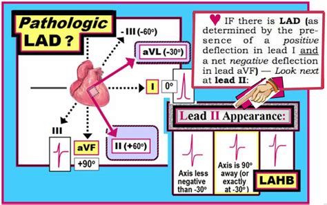 Ecg Interpretation Ecg Interpretation Review 9 Hemiblock Axis Ischemia Vs Normal T Wave