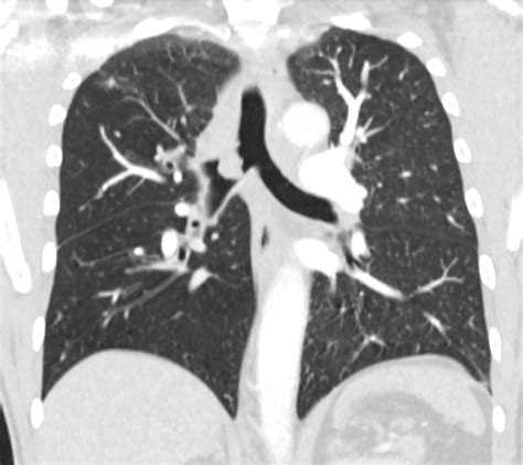 000 Squamous Cell Carcinoma Lungs