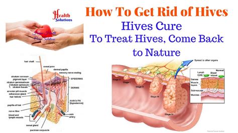 How To Get Rid Of Hives Hives Cure To Treat Hives Come Back To