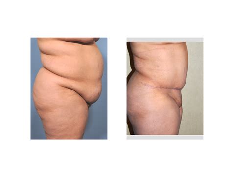 Large Tuck Results Side View Dr Barry Eppley Indianapolis Explore