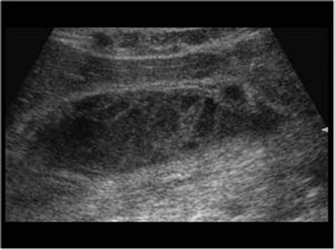 Retroperitoneal Bleed Ultrasound