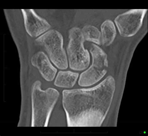 Navicular fracture wrist - rekaomg