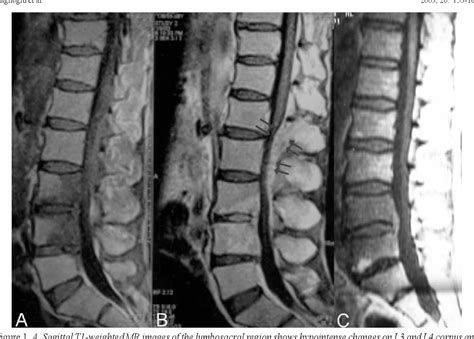 Pdf Lumbar Epidural Abscess Caused By Brucella Species Report Of Two