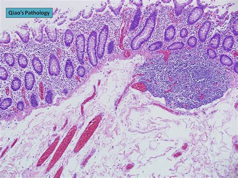 Qiao S Pathology Angiodysplasia Of The Colon Microscopic Flickr