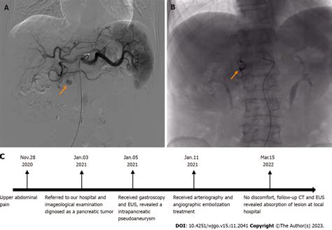 Pancreatic Pseudoaneurysm Mimicking Pancreatic Tumor A Case Report And