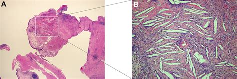 Antrochoanal Polyp Histology