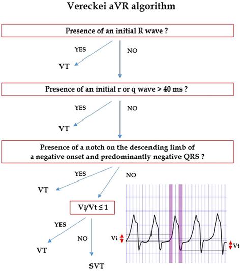 Wide Vs Narrow Qrs Complex