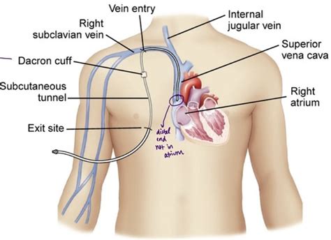 Central Venous Access Devices CVADs Flashcards Quizlet