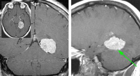 天幕脑膜瘤手术策略与技巧丨the Neurosurgical Atlas全文翻译 脑医汇 神外资讯 神介资讯