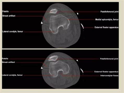 Presentation Pptx Radiological Anatomy Of The Knee Joint Ppt