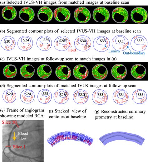 Selected Registered IVUS VH Images And Segmented Contours At Baseline