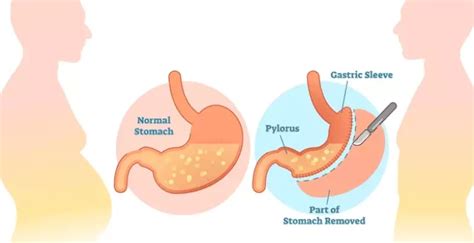 What Is Bariatric Surgery Emerson Health Center Weight Loss