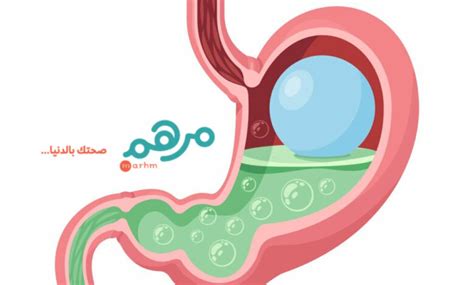وضع بالون في المعدة بالمنظار خيار خفيف لإنقاص الوزن منصة مرهم