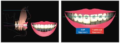 Bracket Positioning For Smile Arc Protection Jco Online Journal Of